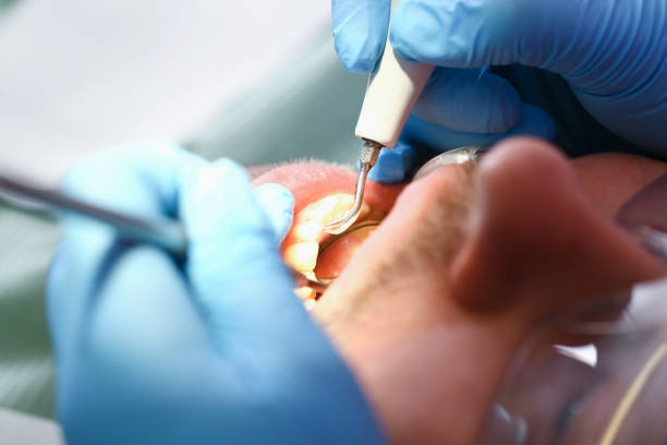 Best Emergency Treatment for Dental Infections or Abscesses in Silver Springs, FL
