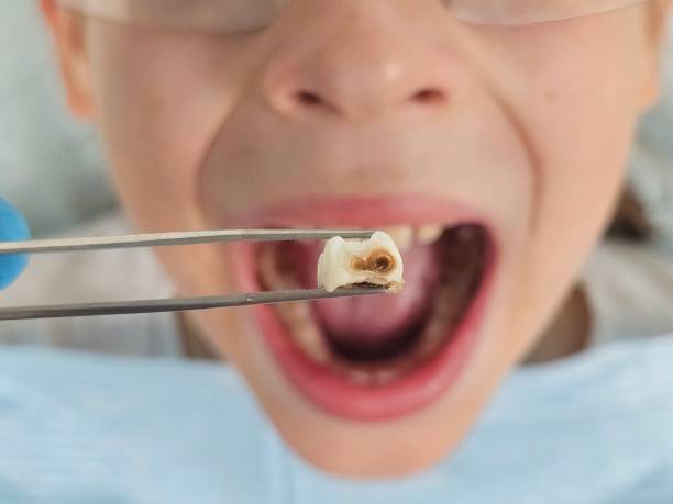 Best Emergency Tooth Extraction in Silver Springs, FL